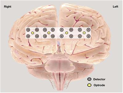 A Cross-Sectional Study on Central Sensitization and Autonomic Changes in Fibromyalgia